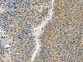 The image on the left is immunohistochemistry of paraffin-embedded Human liver cancer tissue using CSB-PA075666(ASPA Antibody) at dilution 1/60, on the right is treated with fusion protein. (Original magnification: ×200)