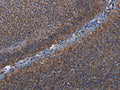 The image on the left is immunohistochemistry of paraffin-embedded Human rectal cancer tissue using CSB-PA075987(LEPREL2 Antibody) at dilution 1/50, on the right is treated with fusion protein. (Original magnification: ×200)