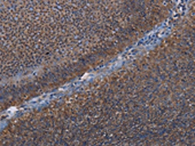 The image on the left is immunohistochemistry of paraffin-embedded Human rectal cancer tissue using CSB-PA075987(LEPREL2 Antibody) at dilution 1/50, on the right is treated with fusion protein. (Original magnification: ×200)