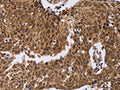 The image on the left is immunohistochemistry of paraffin-embedded Human cervical cancer tissue using CSB-PA076186(ERCC6L Antibody) at dilution 1/30, on the right is treated with fusion protein. (Original magnification: ×200)