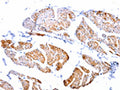 The image on the left is immunohistochemistry of paraffin-embedded Human urinary bladder tissue using CSB-PA076198(CASP2 Antibody) at dilution 1/100, on the right is treated with fusion protein. (Original magnification: ×200)