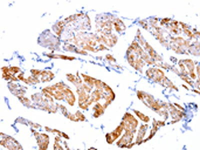 The image on the left is immunohistochemistry of paraffin-embedded Human urinary bladder tissue using CSB-PA076198(CASP2 Antibody) at dilution 1/100, on the right is treated with fusion protein. (Original magnification: ×200)