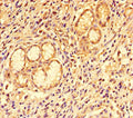 Immunohistochemistry of paraffin-embedded human gastric cancer using CSB-PA07629A0Rb at dilution of 1:100