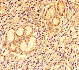 Immunohistochemistry of paraffin-embedded human gastric cancer using CSB-PA07629A0Rb at dilution of 1:100