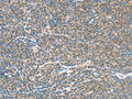 The image on the left is immunohistochemistry of paraffin-embedded Human lymphoma tissue using CSB-PA076734(ATF2 Antibody) at dilution 1/15, on the right is treated with fusion protein. (Original magnification: ×200)