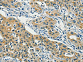 The image on the left is immunohistochemistry of paraffin-embedded Human lung cancer tissue using CSB-PA076840(ASAH2 Antibody) at dilution 1/40, on the right is treated with fusion protein. (Original magnification: ×200)