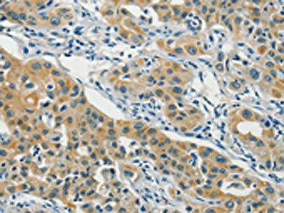 The image on the left is immunohistochemistry of paraffin-embedded Human lung cancer tissue using CSB-PA076840(ASAH2 Antibody) at dilution 1/40, on the right is treated with fusion protein. (Original magnification: ×200)