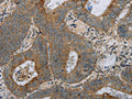 The image on the left is immunohistochemistry of paraffin-embedded Human colon cancer tissue using CSB-PA077030(HSD17B14 Antibody) at dilution 1/30, on the right is treated with fusion protein. (Original magnification: ×200)