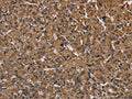 The image on the left is immunohistochemistry of paraffin-embedded Human prostate cancer tissue using CSB-PA077072(HIF1A Antibody) at dilution 1/60, on the right is treated with fusion protein. (Original magnification: ×200)