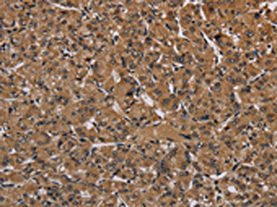 The image on the left is immunohistochemistry of paraffin-embedded Human prostate cancer tissue using CSB-PA077072(HIF1A Antibody) at dilution 1/60, on the right is treated with fusion protein. (Original magnification: ×200)