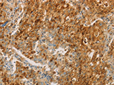The image on the left is immunohistochemistry of paraffin-embedded Human gastic cancer tissue using CSB-PA077200(CEACAM8 Antibody) at dilution 1/30, on the right is treated with fusion protein. (Original magnification: ×200)