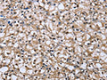 The image on the left is immunohistochemistry of paraffin-embedded Human prostate cancer tissue using CSB-PA078374(DYNLL1 Antibody) at dilution 1/25, on the right is treated with fusion protein. (Original magnification: ×200)