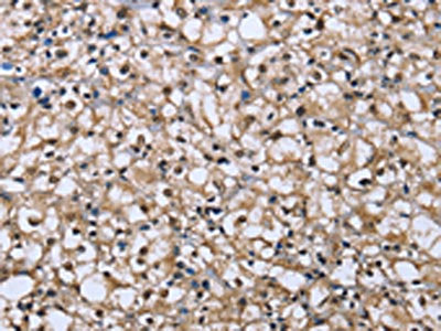 The image on the left is immunohistochemistry of paraffin-embedded Human prostate cancer tissue using CSB-PA078374(DYNLL1 Antibody) at dilution 1/25, on the right is treated with fusion protein. (Original magnification: ×200)