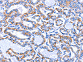 The image on the left is immunohistochemistry of paraffin-embedded Human thyroid cancer tissue using CSB-PA078489(GJB3 Antibody) at dilution 1/30, on the right is treated with fusion protein. (Original magnification: ×200)