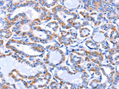 The image on the left is immunohistochemistry of paraffin-embedded Human thyroid cancer tissue using CSB-PA078489(GJB3 Antibody) at dilution 1/30, on the right is treated with fusion protein. (Original magnification: ×200)