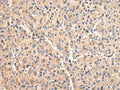 The image on the left is immunohistochemistry of paraffin-embedded Human liver cancer tissue using CSB-PA078497(VCAM1 Antibody) at dilution 1/30, on the right is treated with fusion protein. (Original magnification: ×200)
