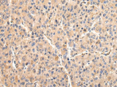 The image on the left is immunohistochemistry of paraffin-embedded Human liver cancer tissue using CSB-PA078497(VCAM1 Antibody) at dilution 1/30, on the right is treated with fusion protein. (Original magnification: ×200)