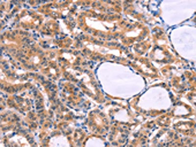 The image on the left is immunohistochemistry of paraffin-embedded Human thyroid cancer tissue using CSB-PA078505(CYP1B1 Antibody) at dilution 1/20, on the right is treated with fusion protein. (Original magnification: ×200)