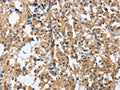 The image on the left is immunohistochemistry of paraffin-embedded Human thyroid cancer tissue using CSB-PA078640(GAB1 Antibody) at dilution 1/40, on the right is treated with fusion protein. (Original magnification: ×200)