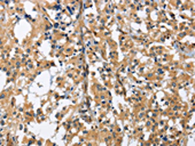 The image on the left is immunohistochemistry of paraffin-embedded Human thyroid cancer tissue using CSB-PA078640(GAB1 Antibody) at dilution 1/40, on the right is treated with fusion protein. (Original magnification: ×200)