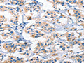 The image on the left is immunohistochemistry of paraffin-embedded Human thyroid cancer tissue using CSB-PA078954(AHR Antibody) at dilution 1/50, on the right is treated with synthetic peptide. (Original magnification: ×200)