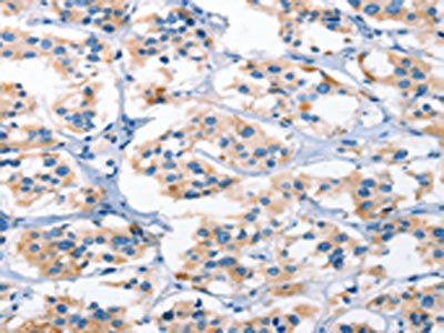 The image on the left is immunohistochemistry of paraffin-embedded Human thyroid cancer tissue using CSB-PA078954(AHR Antibody) at dilution 1/50, on the right is treated with synthetic peptide. (Original magnification: ×200)