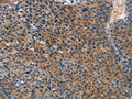 The image on the left is immunohistochemistry of paraffin-embedded Human liver cancer tissue using CSB-PA078977(STAMBP Antibody) at dilution 1/15, on the right is treated with fusion protein. (Original magnification: ×200)