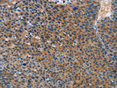 The image on the left is immunohistochemistry of paraffin-embedded Human liver cancer tissue using CSB-PA078977(STAMBP Antibody) at dilution 1/15, on the right is treated with fusion protein. (Original magnification: ×200)