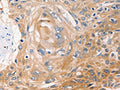The image on the left is immunohistochemistry of paraffin-embedded Human esophagus cancer tissue using CSB-PA079049(NME1 Antibody) at dilution 1/40, on the right is treated with fusion protein. (Original magnification: ×200)