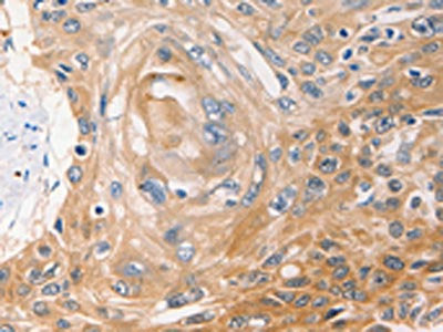The image on the left is immunohistochemistry of paraffin-embedded Human esophagus cancer tissue using CSB-PA079049(NME1 Antibody) at dilution 1/40, on the right is treated with fusion protein. (Original magnification: ×200)