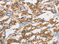 The image is immunohistochemistry of paraffin-embedded Human thyroid cancer tissue using CSB-PA079169(SAR1B Antibody) at dilution 1/20. (Original magnification: ×200)