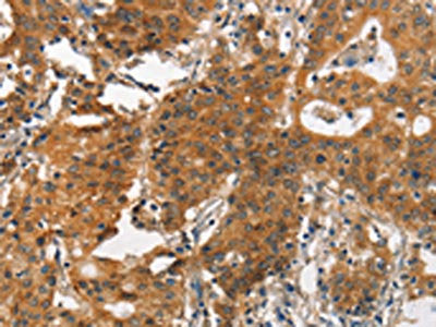 The image on the left is immunohistochemistry of paraffin-embedded Human gastic cancer tissue using CSB-PA079340(ITGA2 Antibody) at dilution 1/30, on the right is treated with synthetic peptide. (Original magnification: ×200)