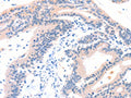 The image on the left is immunohistochemistry of paraffin-embedded Human colon cancer tissue using CSB-PA079709(ITGA6 Antibody) at dilution 1/50, on the right is treated with synthetic peptide. (Original magnification: ×200)