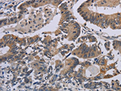 The image on the left is immunohistochemistry of paraffin-embedded Human colon cancer tissue using CSB-PA079873(CCL1 Antibody) at dilution 1/50, on the right is treated with synthetic peptide. (Original magnification: ×200)
