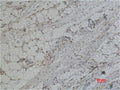 Immunohistochemical analysis of paraffin-embedded Human Heptocaricnoma using PRX I Polyclonal Antibody.