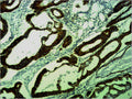 Immunohistochemical analysis of paraffin-embedded human Colon caricnoma using COX4 Polyclonal Antibody.