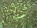 Immunohistochemical analysis of paraffin-embedded human Lung caricnoma using E-cadherin Polyclonal Antibody.