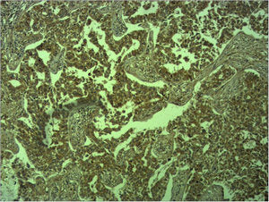 Immunohistochemical analysis of paraffin-embedded human Lung caricnoma using E-cadherin Polyclonal Antibody.