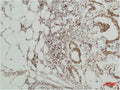 Immunohistochemical analysis of paraffin-embedded human Breast caricnoma using ERK 5 Polyclonal Antibody.