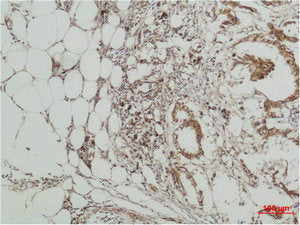 Immunohistochemical analysis of paraffin-embedded human Breast caricnoma using ERK 5 Polyclonal Antibody.