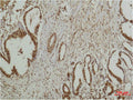 Immunohistochemical analysis of paraffin-embedded human Breast caricnoma using ERK 5 Polyclonal Antibody.