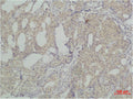 Immunohistochemical analysis of paraffin-embedded human Breast caricnoma using SLUG Polyclonal Antibody.