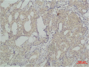 Immunohistochemical analysis of paraffin-embedded human Breast caricnoma using SLUG Polyclonal Antibody.