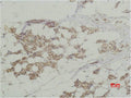 Immunohistochemical analysis of paraffin-embedded human Breast caricnoma using Histone H3 Polyclonal Antibody.