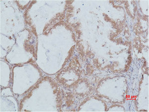 Immunohistochemical analysis of paraffin-embedded Human Lung caricnoma using Stat2 Polyclonal Antibody.