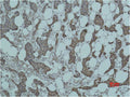 Immunohistochemical analysis of paraffin-embedded human Breast caricnoma using Smad3 Polyclonal Antibody.