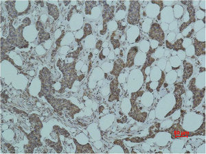 Immunohistochemical analysis of paraffin-embedded human Breast caricnoma using Smad3 Polyclonal Antibody.
