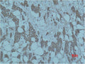 Immunohistochemical analysis of paraffin-embedded human Breast caricnoma using Smad3 Polyclonal Antibody.
