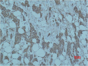 Immunohistochemical analysis of paraffin-embedded human Breast caricnoma using Smad3 Polyclonal Antibody.