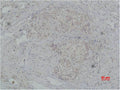Immunohistochemical analysis of paraffin-embedded human breast caricnoma using PI 3-Kinase p85β Polyclonal Antibody.